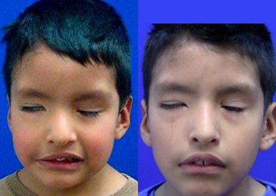 clinica-nervio-facial-casos-de-exito