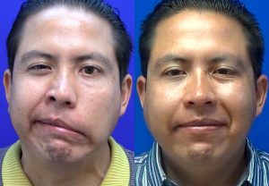 clinica-nervio-facial-casos-de-exito