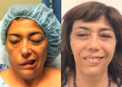 clinica-nervio-facial-casos-de-exito