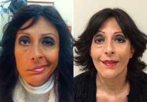 clinica-nervio-facial-casos-de-exito