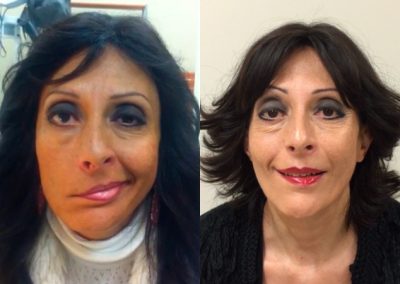 clinica-nervio-facial-casos-de-exito