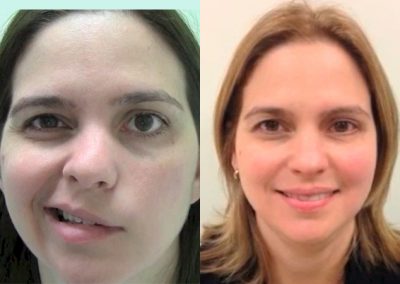 clinica-nervio-facial-casos-de-exito