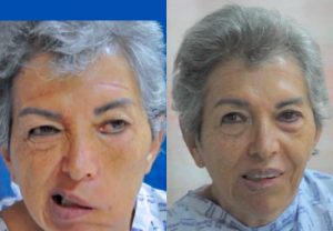 clinica-nervio-facial-casos-de-exito