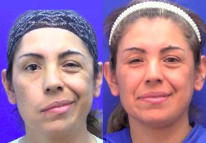 clinica-nervio-facial-casos-de-exito