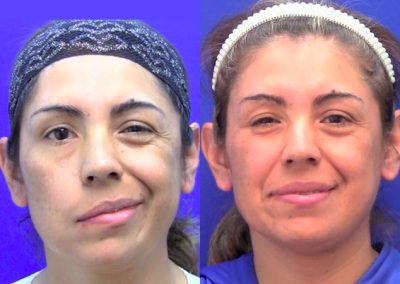 clinica-nervio-facial-casos-de-exito