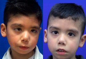 clinica-nervio-facial-casos-de-exito