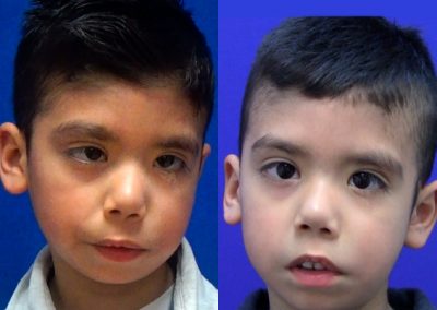 clinica-nervio-facial-casos-de-exito