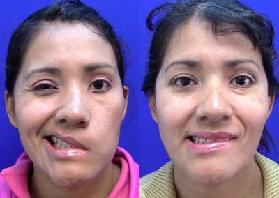 clinica-nervio-facial-casos-de-exito