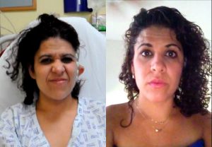 clinica-nervio-facial-casos-de-exito