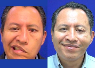 clinica-nervio-facial-casos-de-exito